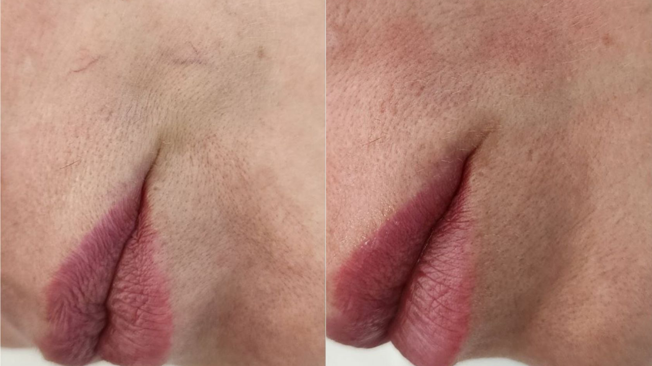 Фото до и после: удаление сосудов лазером в клинике PradusCOSMO, Санкт-Петербург. Безопасно, эффективно и без повреждений кожи