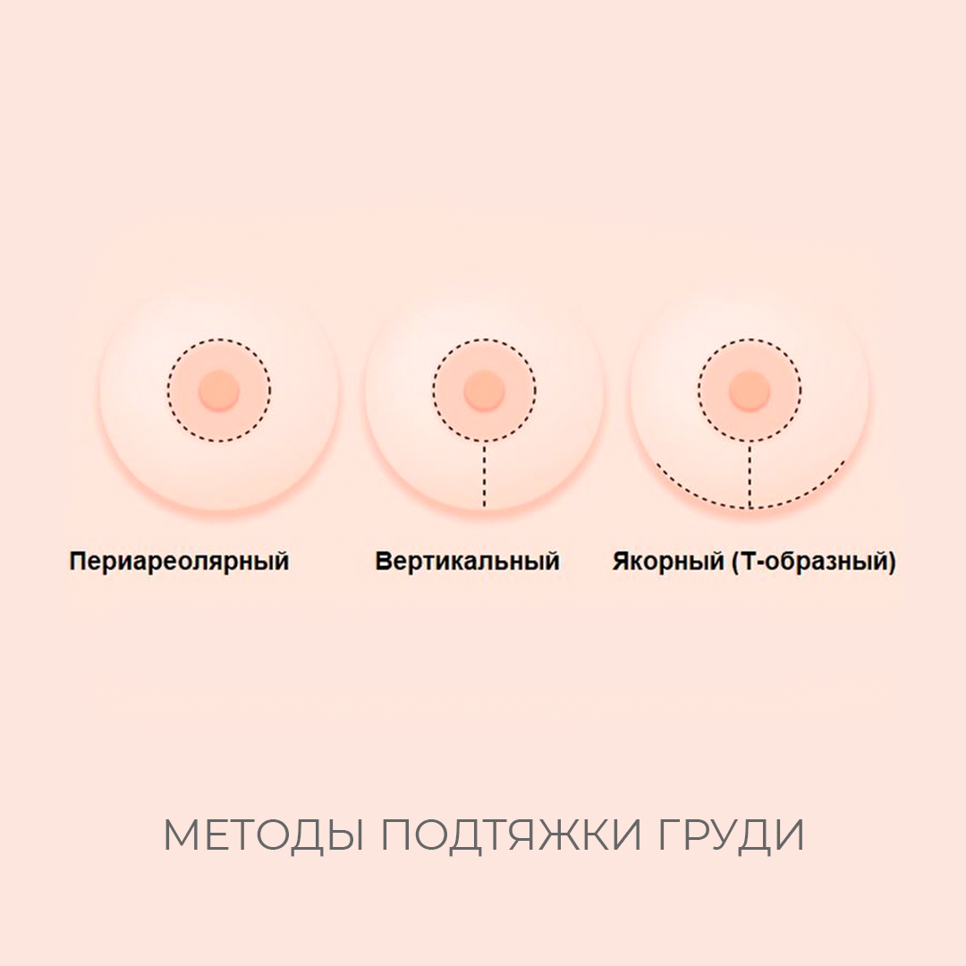 мастопексия на одну грудь фото 104