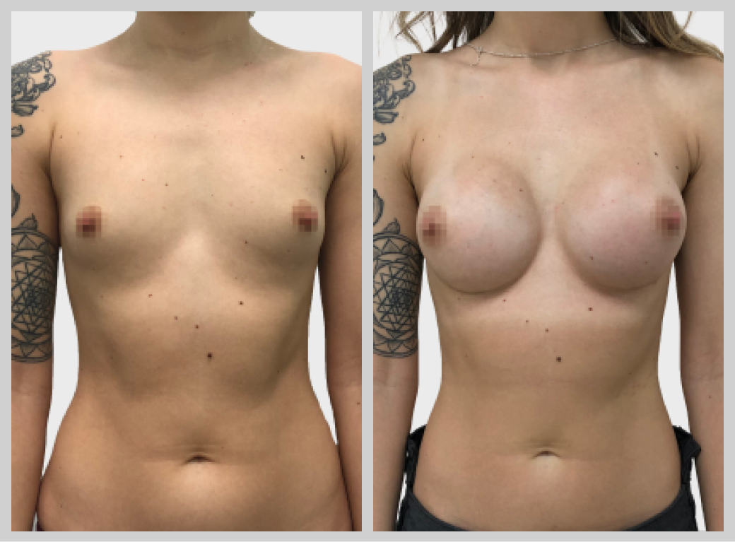 маммопластика увеличение груди импланты