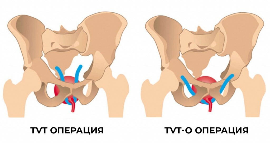 Разрывы влагалища и другие травмы женских половых органов