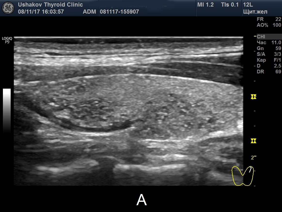 узи щитовидной волгоград. узи щитовидной волгоград. узи щитовидной волгоград. солдатова врач узи. узи, узел левой доли щитовидной железы.
