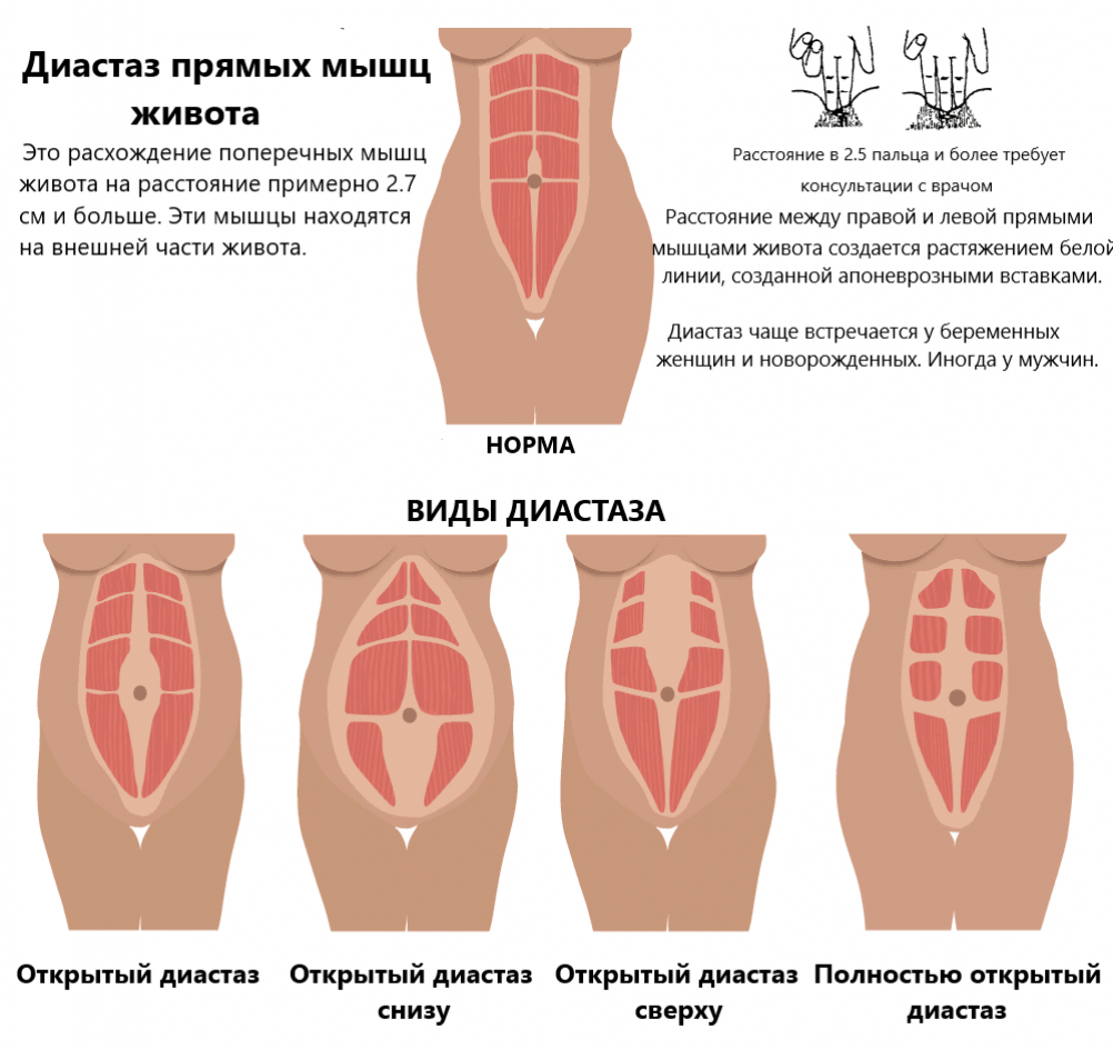 Диагностика диастаза в Юсуповской больнице: методы определения расхождения