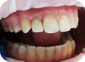 После имплантации