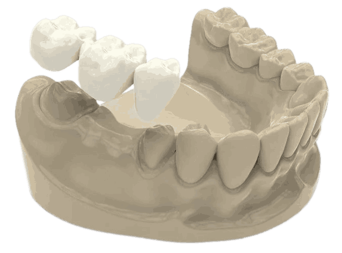 Протезы передних зубов в стоматологии Барышева ☎ +7 (908) 237-73-77 