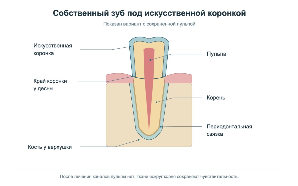 Ткани зуба и корня под искусственной коронкой