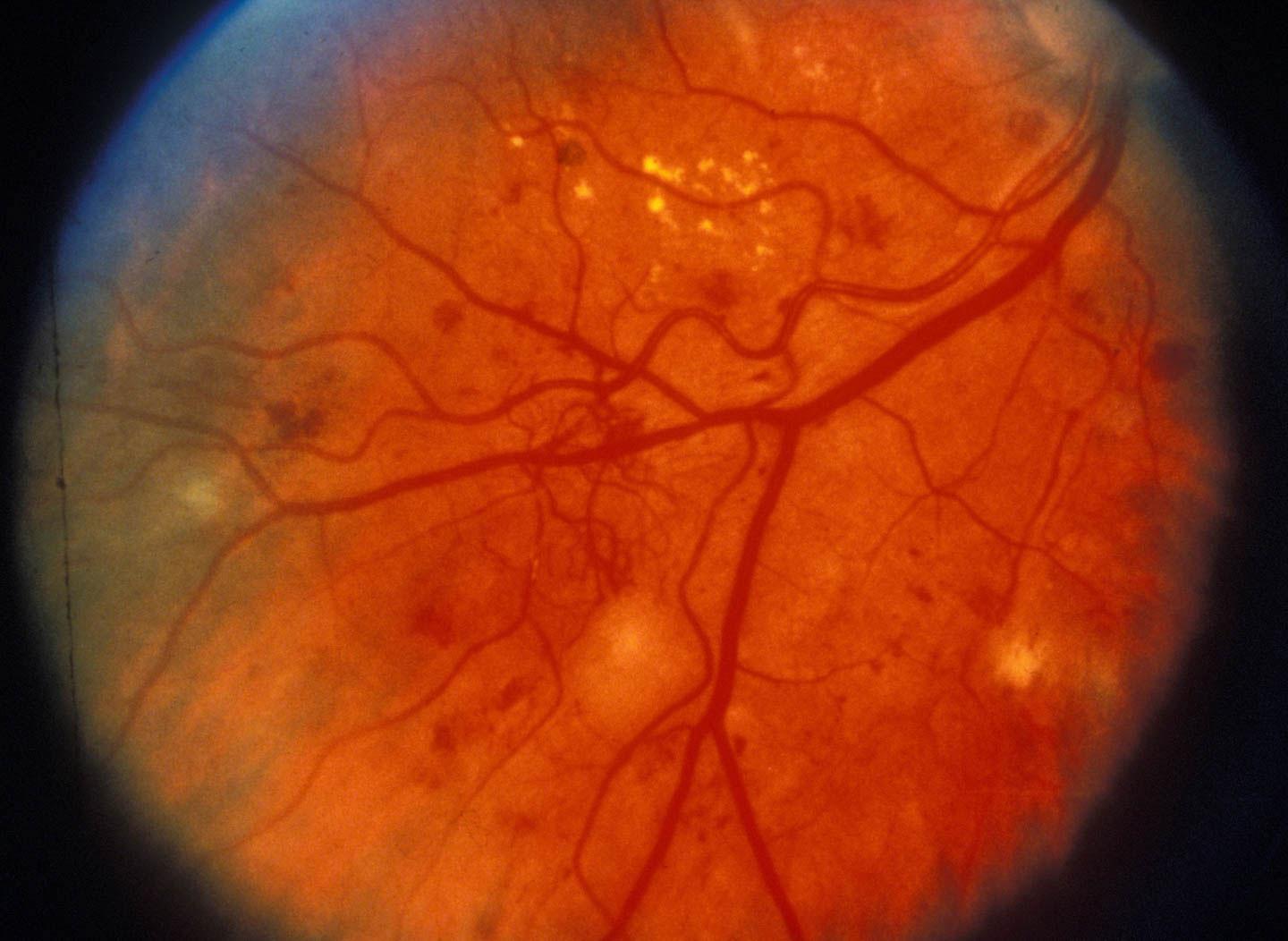День сетчатки. Диабетическая ретинопатия глазное дно. Пролиферативная ретинопатия. Пролиферативная диабетическая ретинопатия.