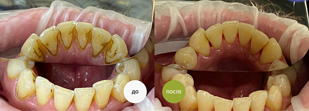 Удаление зубного камня - пример работы клиники Этна-Дент