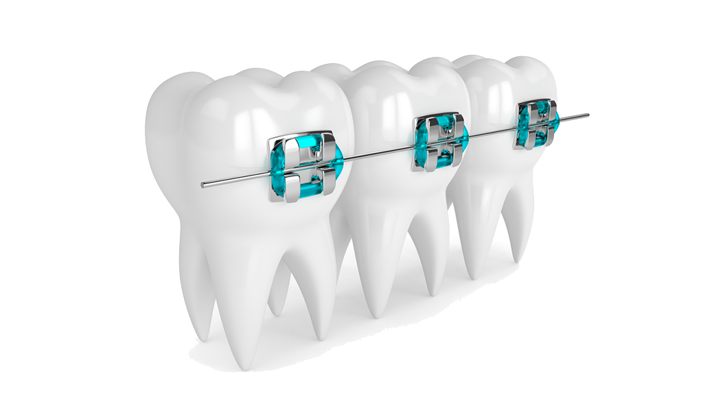 Лигатурная брекет система Biomim. Ортодонтия в стоматологии. Two tooths