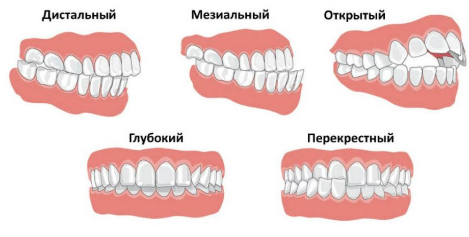 Неправильный прикус картинки