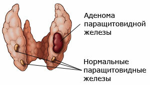 Гиперпаратиреоз: симптомы, лечение, консультация, причины, диагностика.