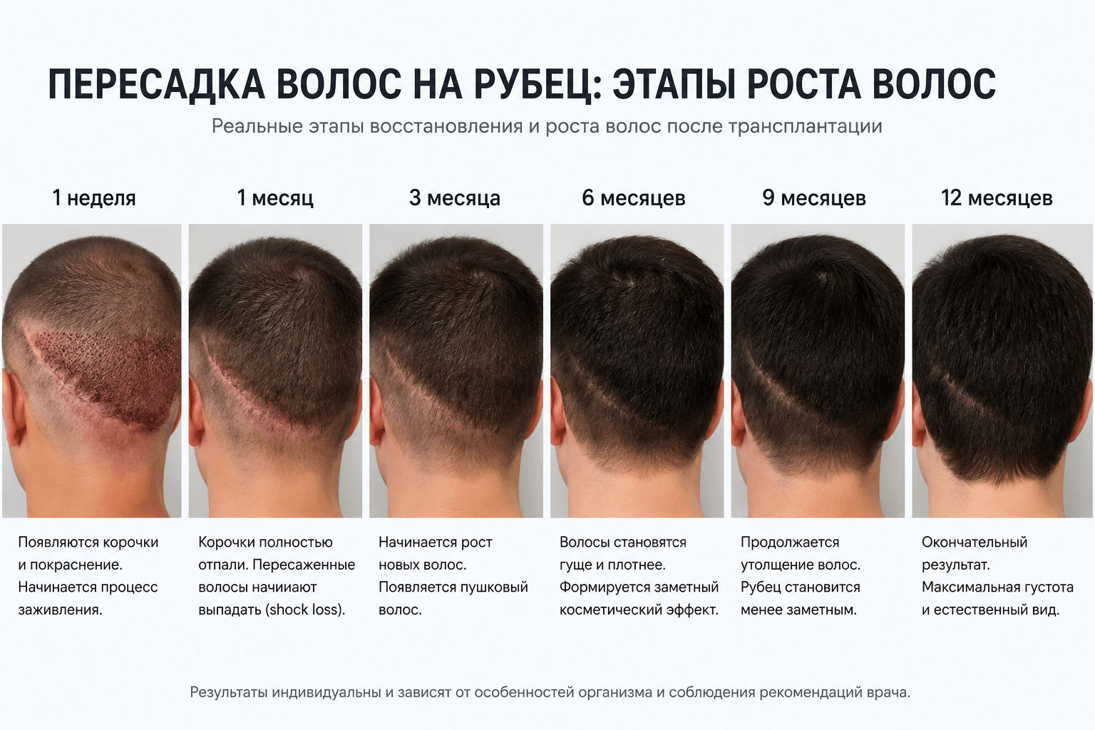 пересадка волос на рубец этапы роста