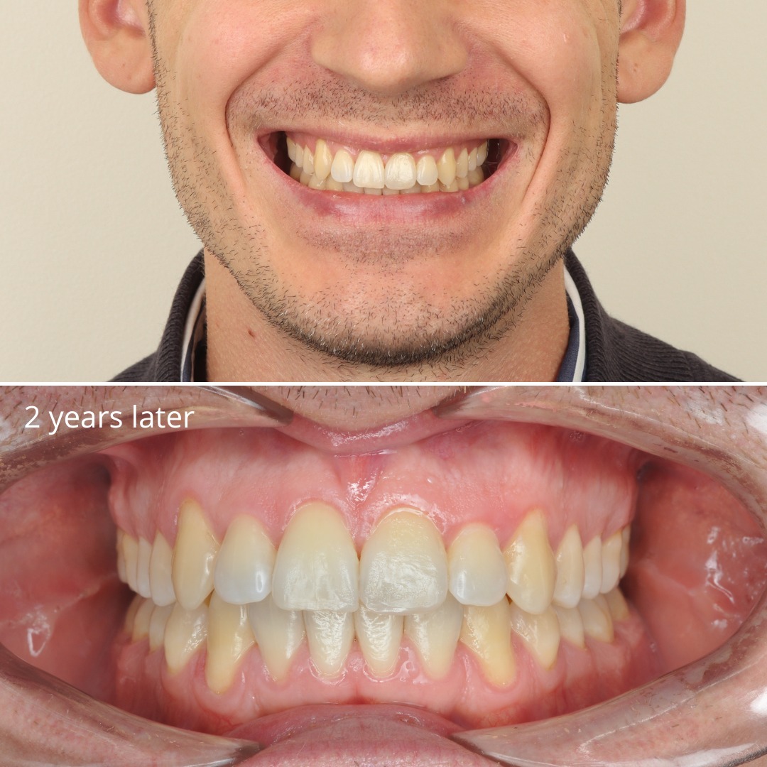 After photo showing recovered canine space and stable functional occlusion — photo 3 of 3