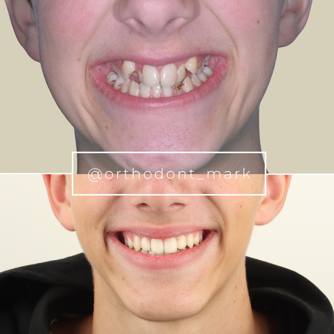 Before treatment: crowded dentition with skeletal narrowing of the upper jaw — photo 1 of 3
