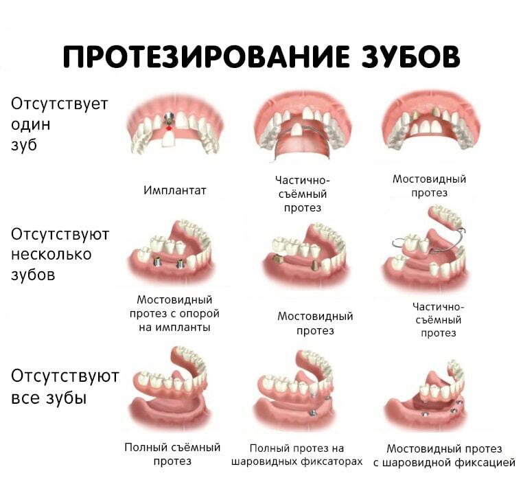 Какие есть виды протезирования зубов фото