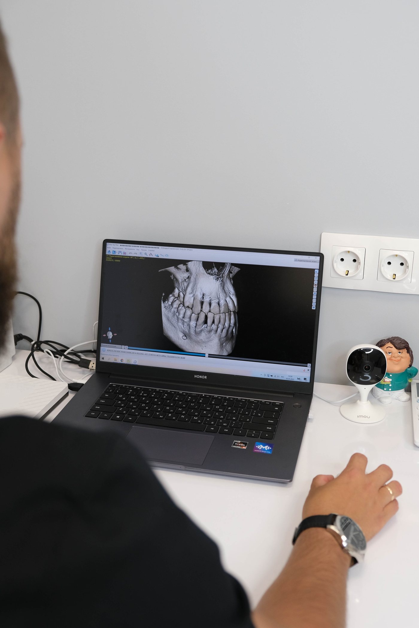 этапы имплантации зубов 3D снимок челюсти