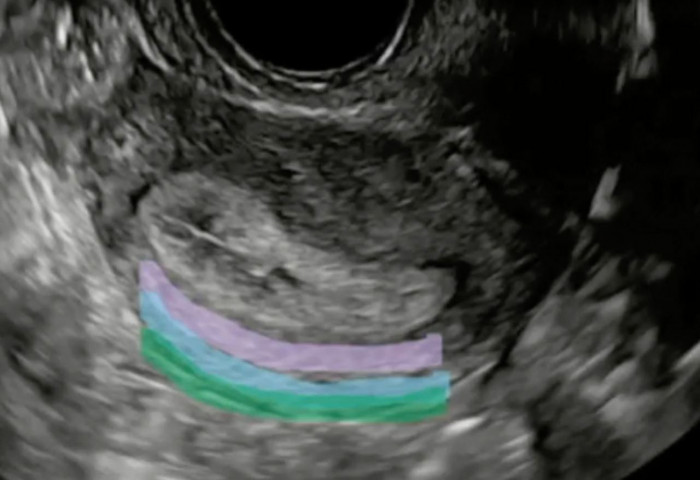 УЗИ В ГИНЕКОЛОГИИ - ЭТО ЛЕГКО