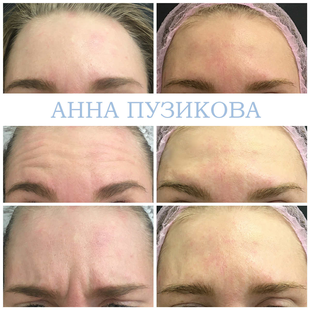 Результат ботулинотерапии — коррекция мимических морщин на лбу и в области глаз. Косметолог Пузикова Анна Анатольевна, Санкт-Петербург