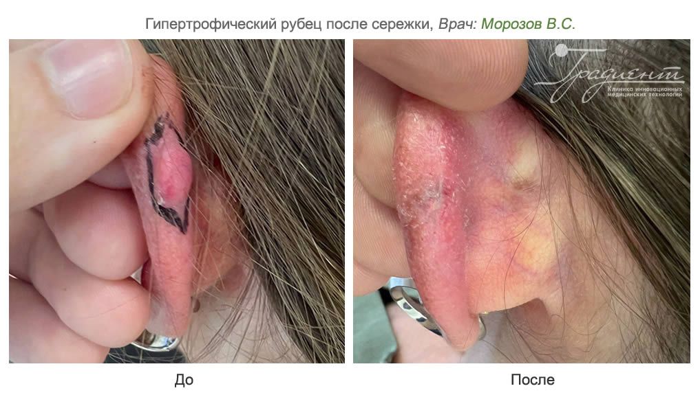 Лечение послеоперационных рубцов в клинике Dekamedical в Москве