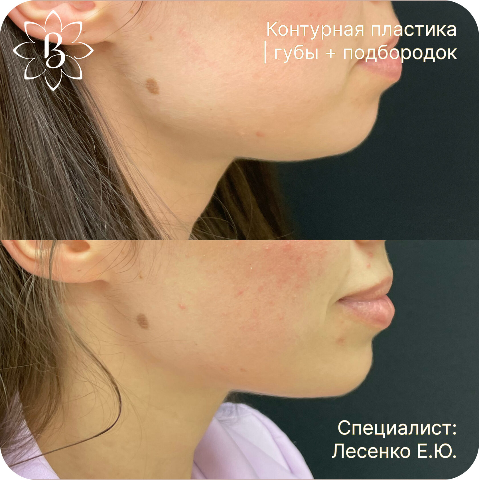 Александритовая лазерная эпиляция