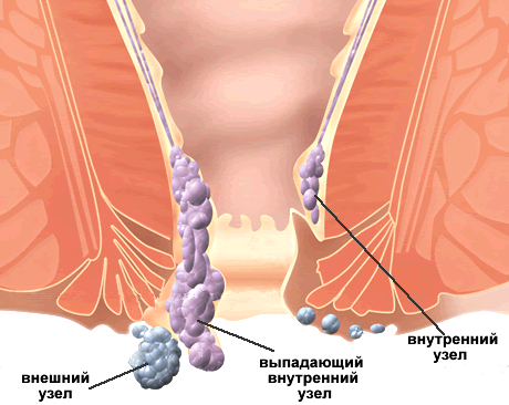 Наружный геморрой. Что это и как лечить?