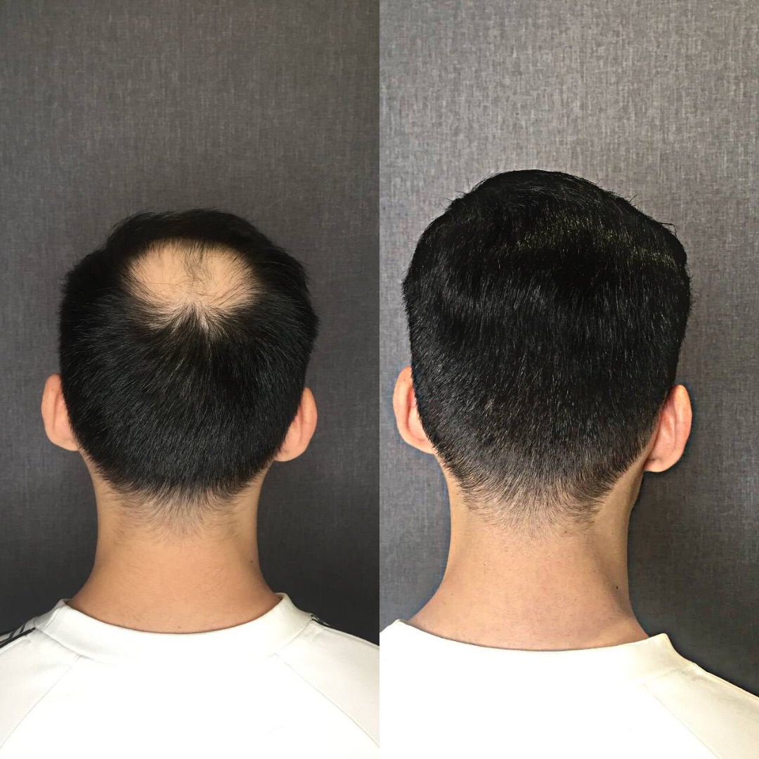 Система волос для мужчин до и после