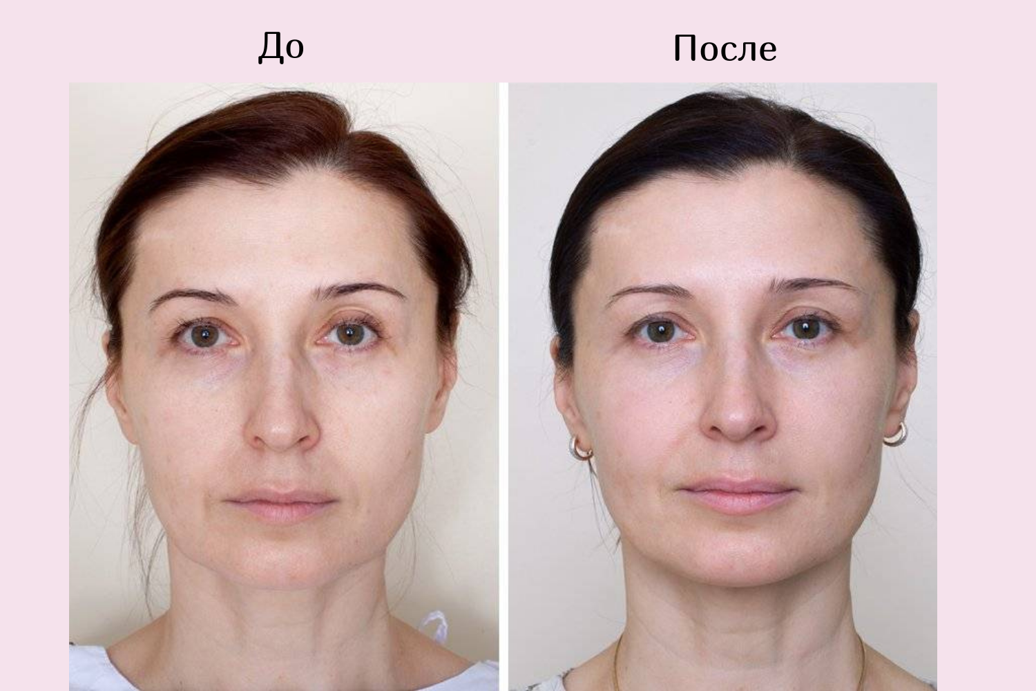 Тонирование лица косметология фото до и после