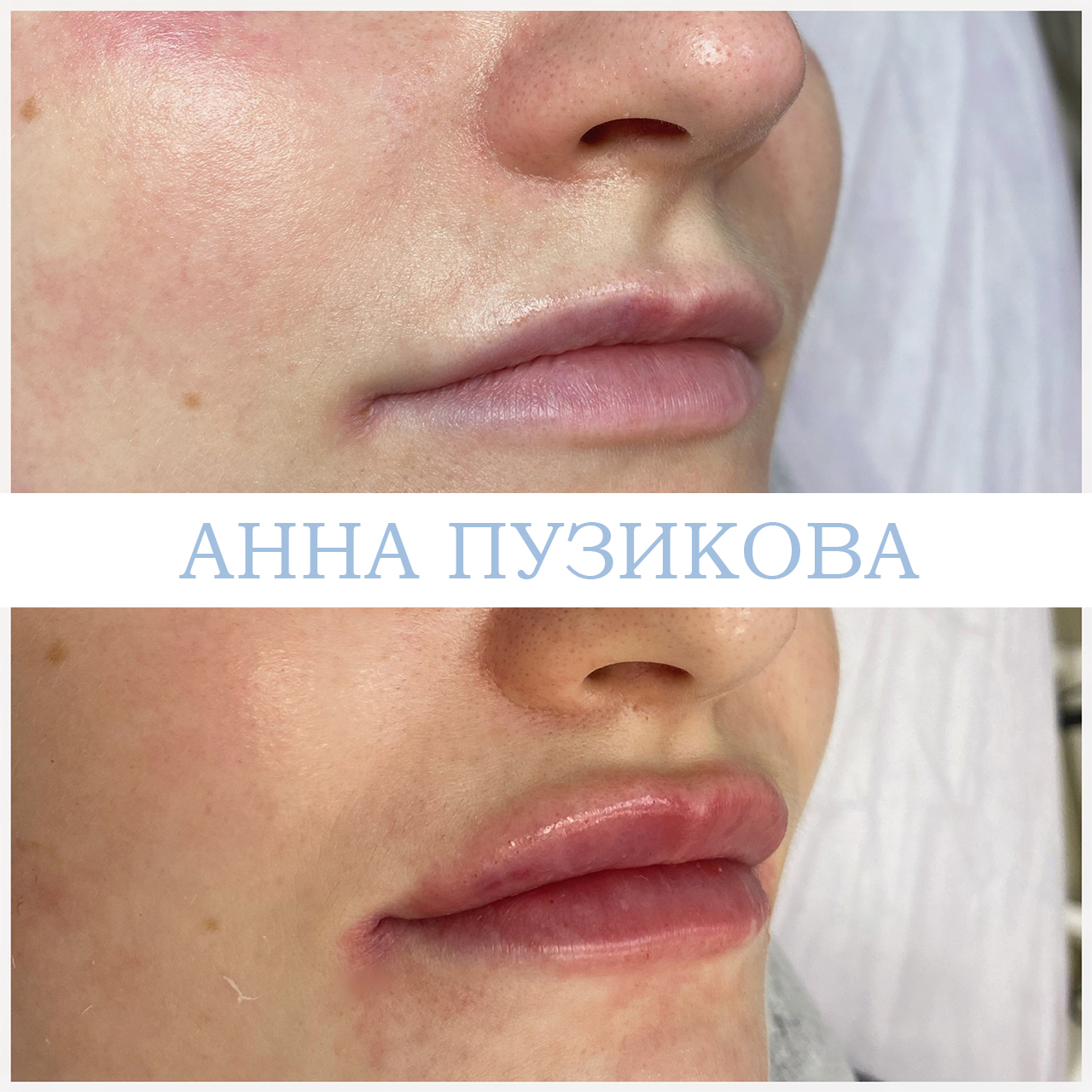 Контурная пластика губ гиалуроновым филлером — естественный результат без утраты пропорций. Косметолог Пузикова Анна Анатольевна, Санкт-Петербург.