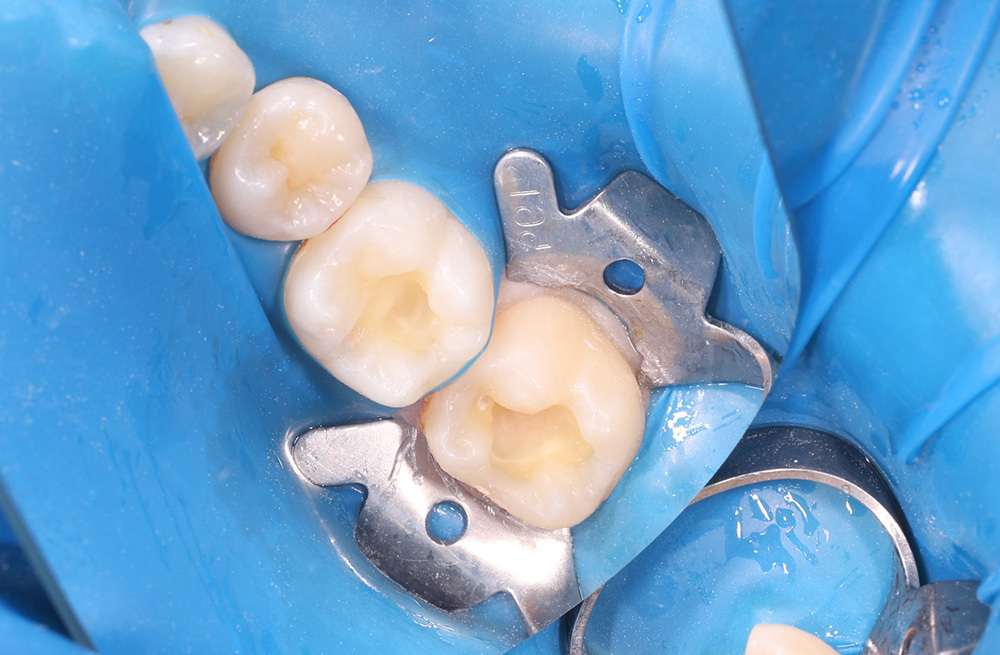 Композитная реставрация жевательных зубов при кариозном поражении