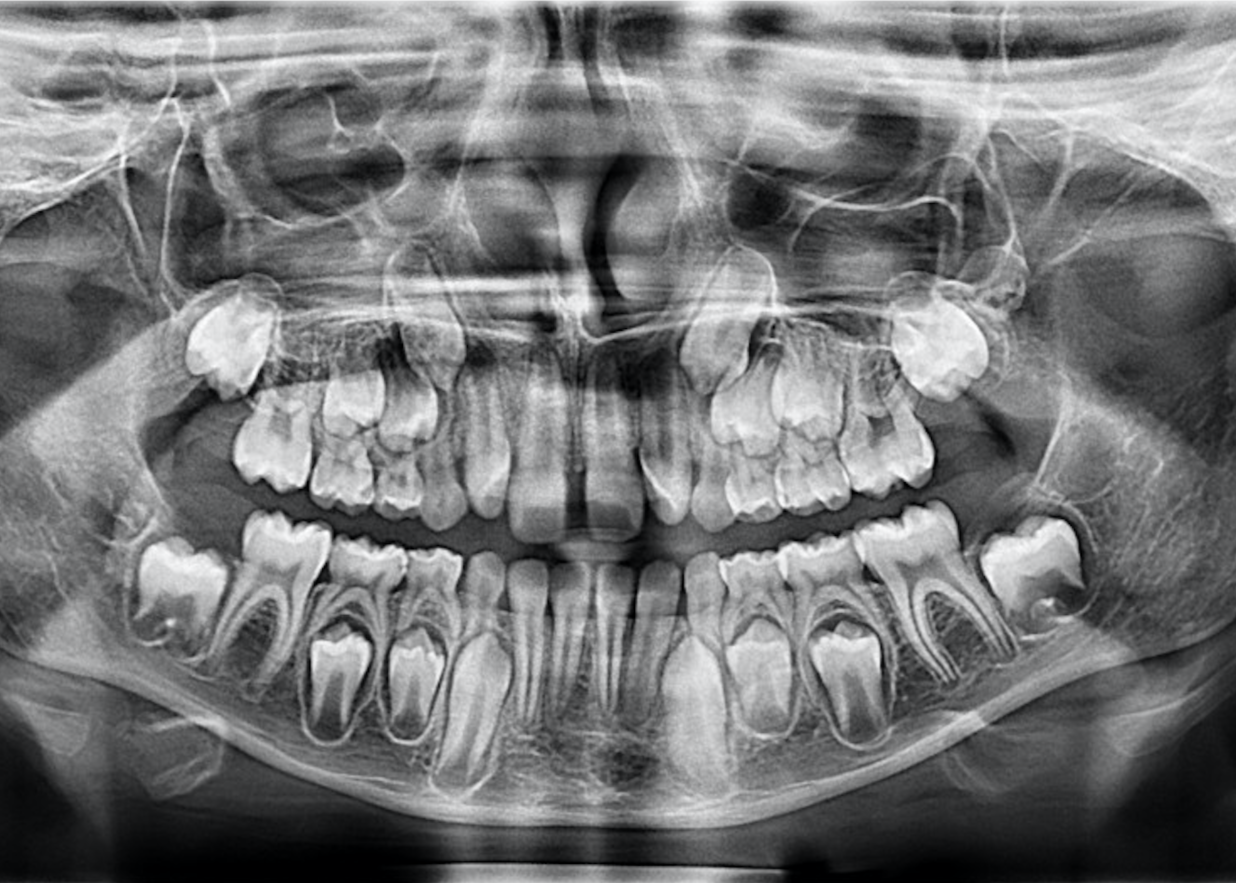 Панорамный снимок зубов Томск Буткеевская стоматология томск коронки