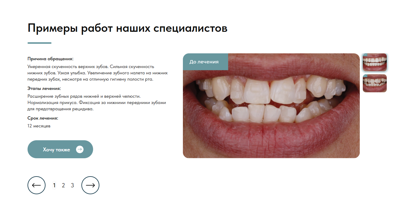 Пример работы ортодонтов до лечения на элайнерах