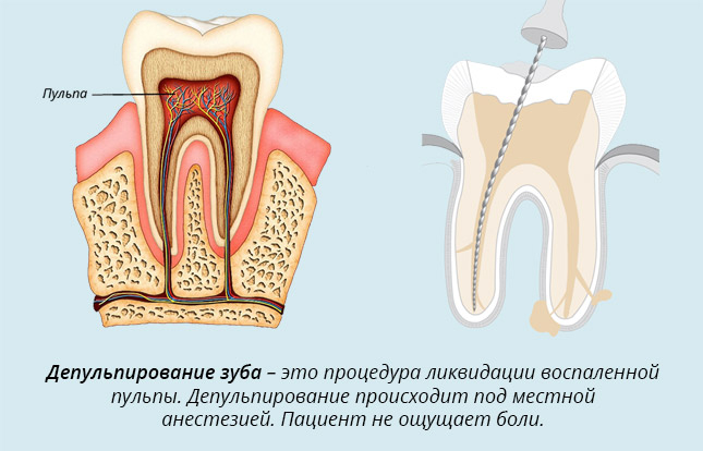Удаление зубного нерва в Тюмени 👍 Чистка и пломбирование каналов зуба, цена