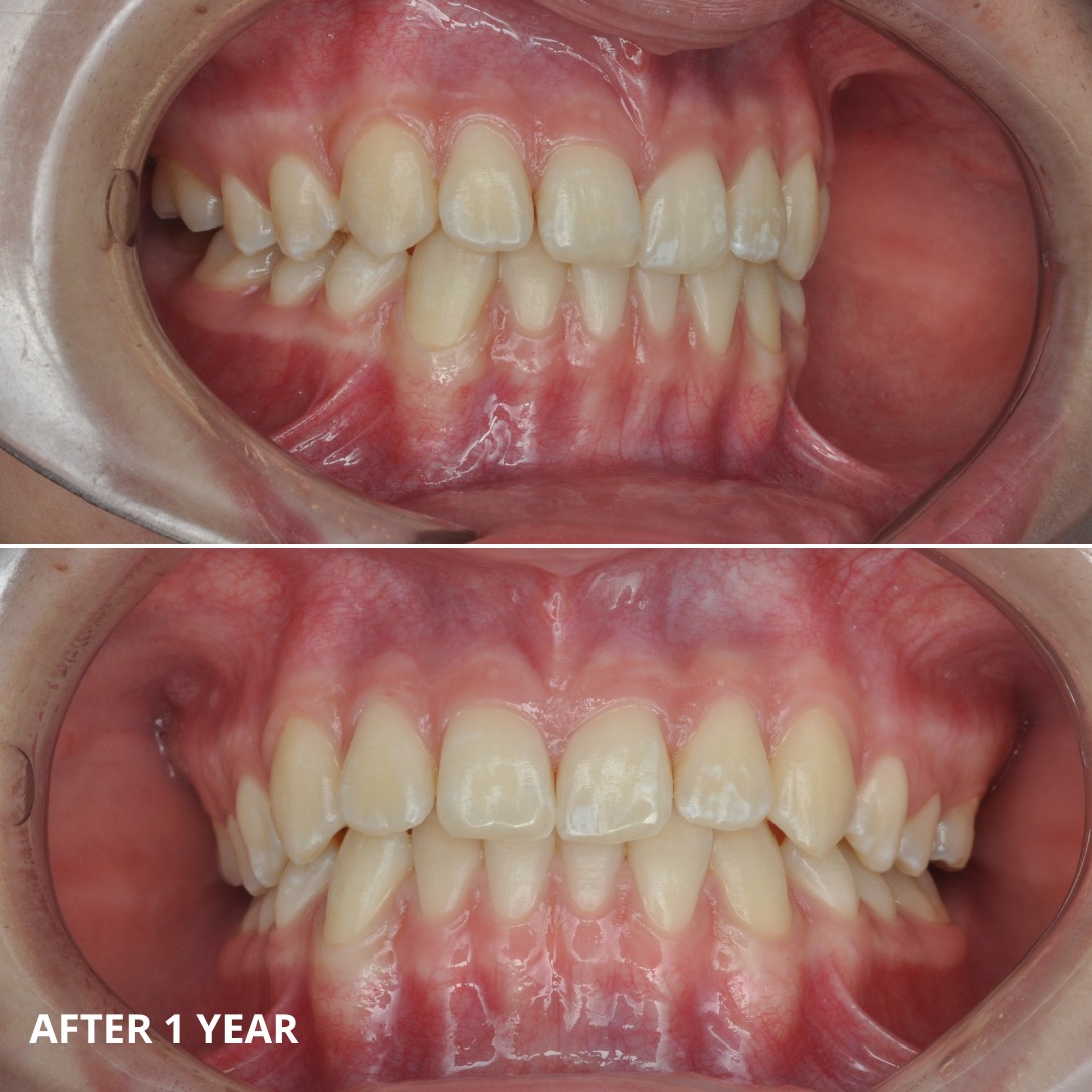 After result showing corrected mesial bite achieved with MARPE and Face Mask therapy — photo 7 of 7