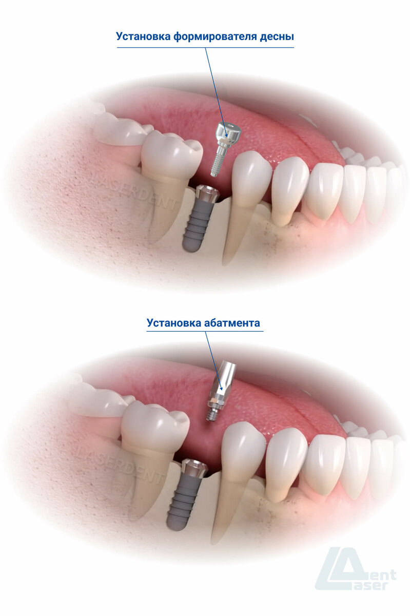 Имплантация зубов в стоматологии Лазердент Хабаровск