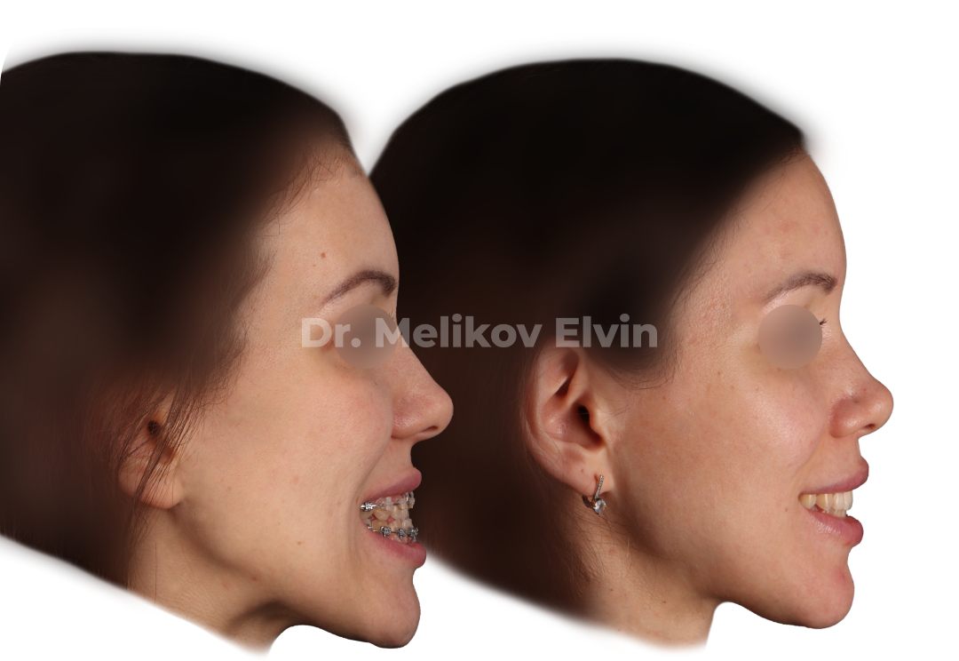 Ортогнатическая операция при мезиальном прикусе.