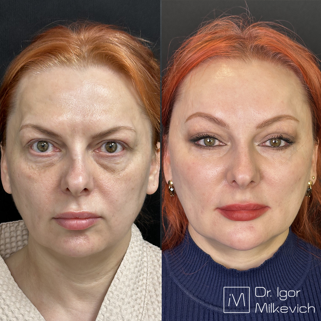 Периорбитопластика и эндоскопическая подтяжка верхней и средней трети лица — до операции и через 2 года
