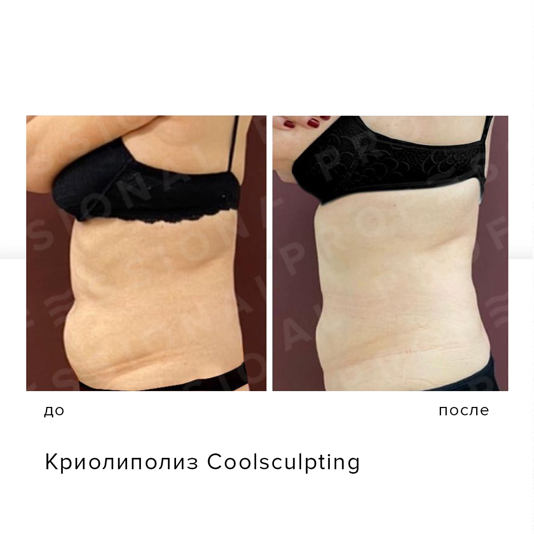 Аппаратная липосакция Coolsculpting - уничтожает жировые отложения без  скальпеля за одну процедуру | Клиника косметологии PROFESSIONAL в Москве