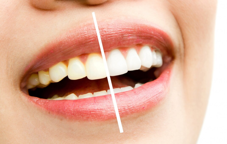 Фотоотбеливание зубов в Москве по доступным ценам