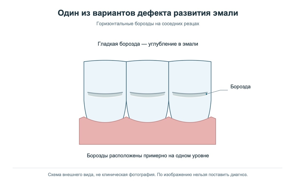 Пример дефекта развития эмали; изображение иллюстрирует внешний вид и не предназначено для самодиагностики