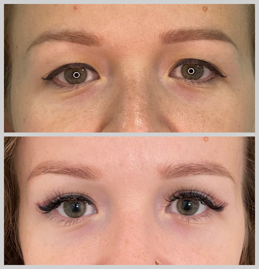 блефаропластика нависшие веки