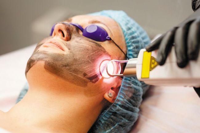 ЛАЗЕРНАЯ ЧИСТКА ЛИЦА