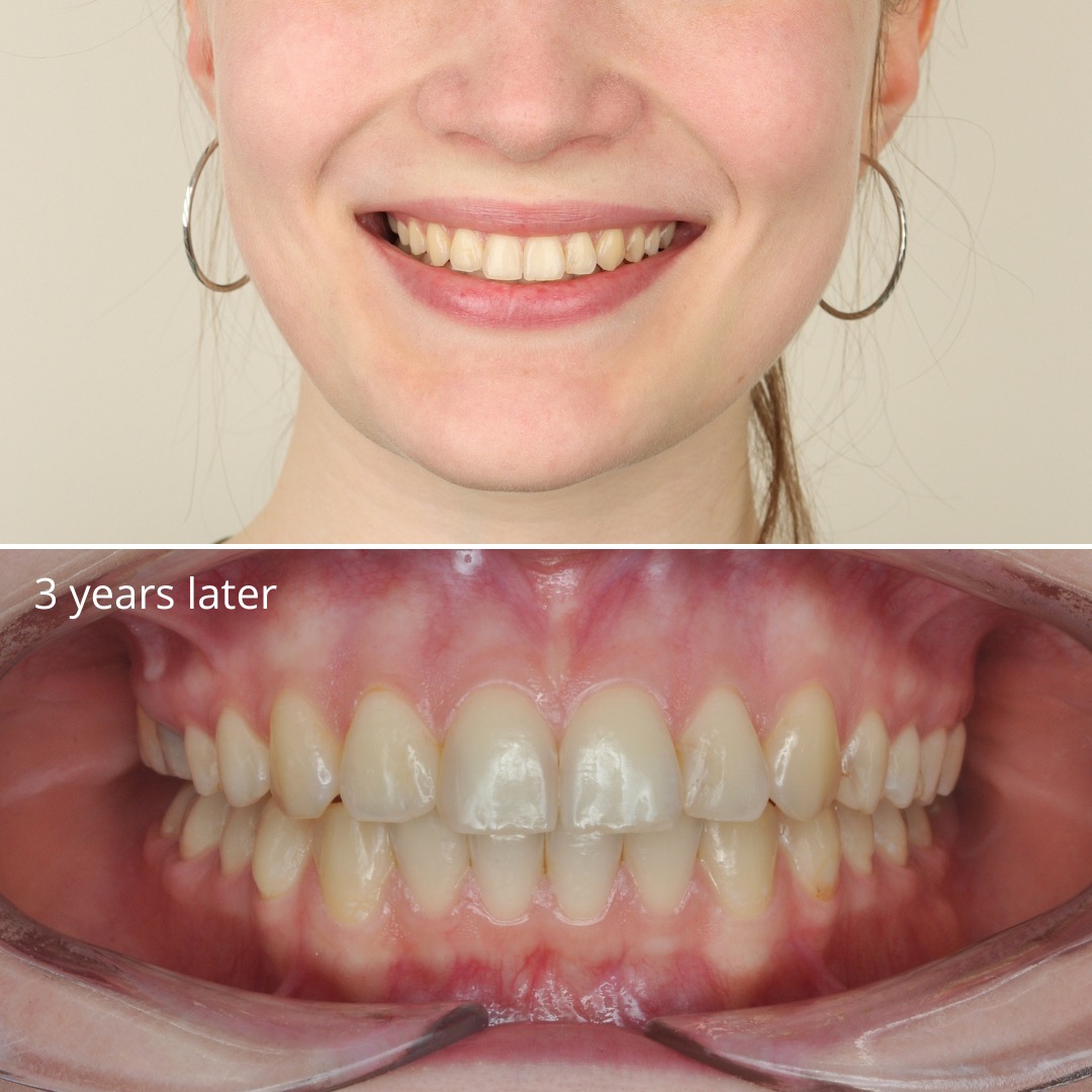 After photo showing a neat, harmonious smile stable after years of retention — photo 5 of 5