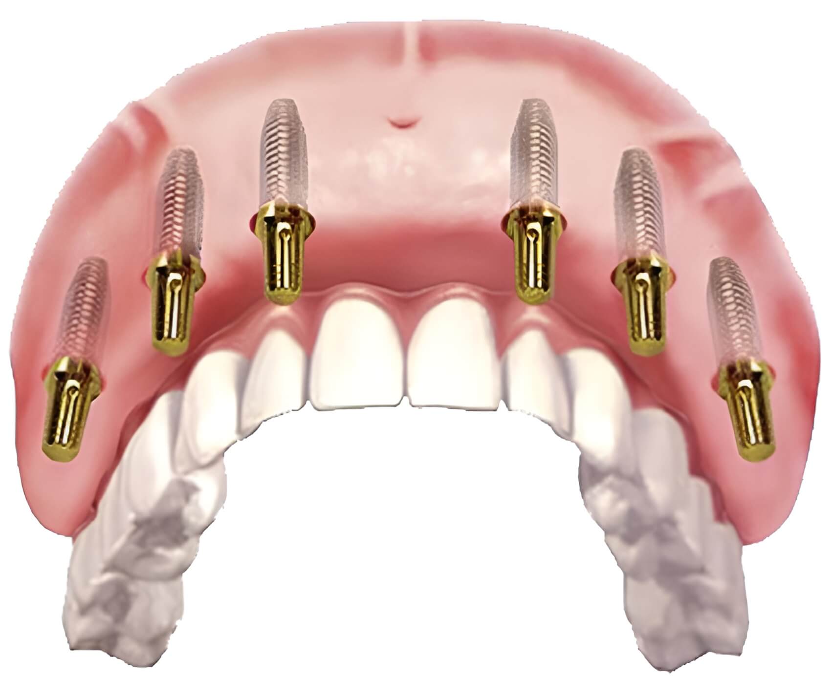 Все На 6 Имплантах Цена Под Ключ