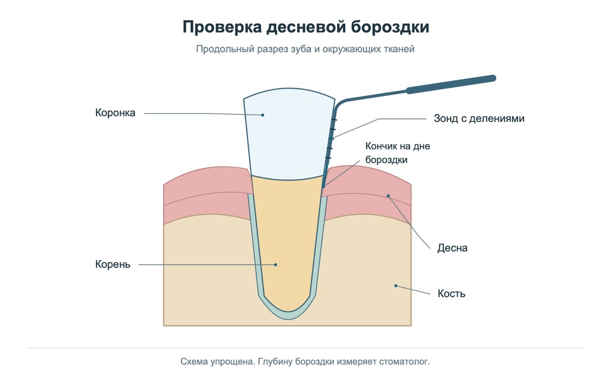Пародонтальный зонд в десневой бороздке