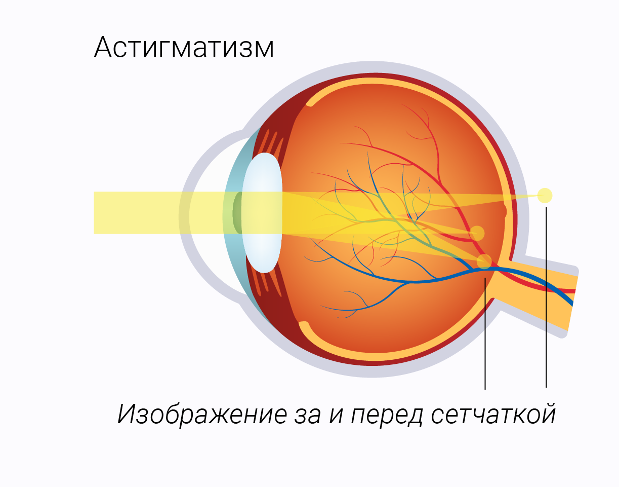 Аметропии: миопия, гиперметропия, астигматизм. Близорукость астигматизм у ребенка. Миопия схема глаза. Миопия гиперметропия астигматизм пресбиопия. Астигматизм.