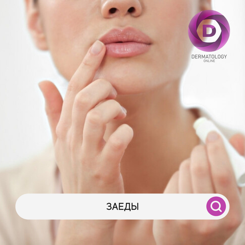 Заеды на губах - причины появления, лечение