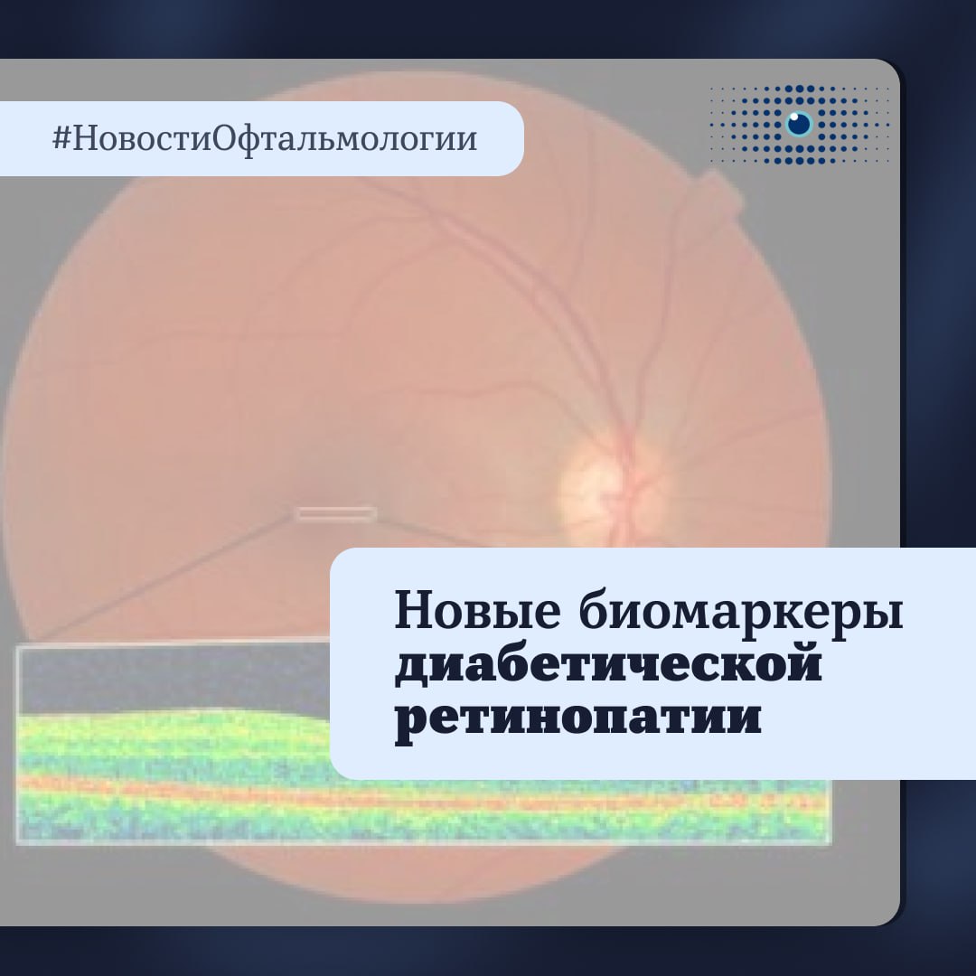 Источник: https://www.ophthalmologytimes.com/view/retinal-imaging-study-suggests-new-biomarkers-for-early-diabetic-retinopathy-detection