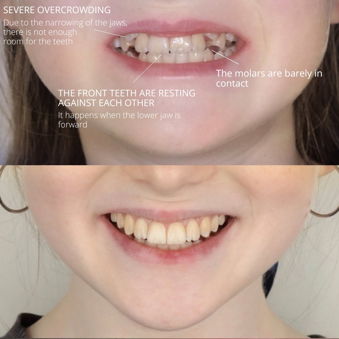 Detailed view highlighting the shape of the upper lateral incisors during treatment — photo 2 of 3