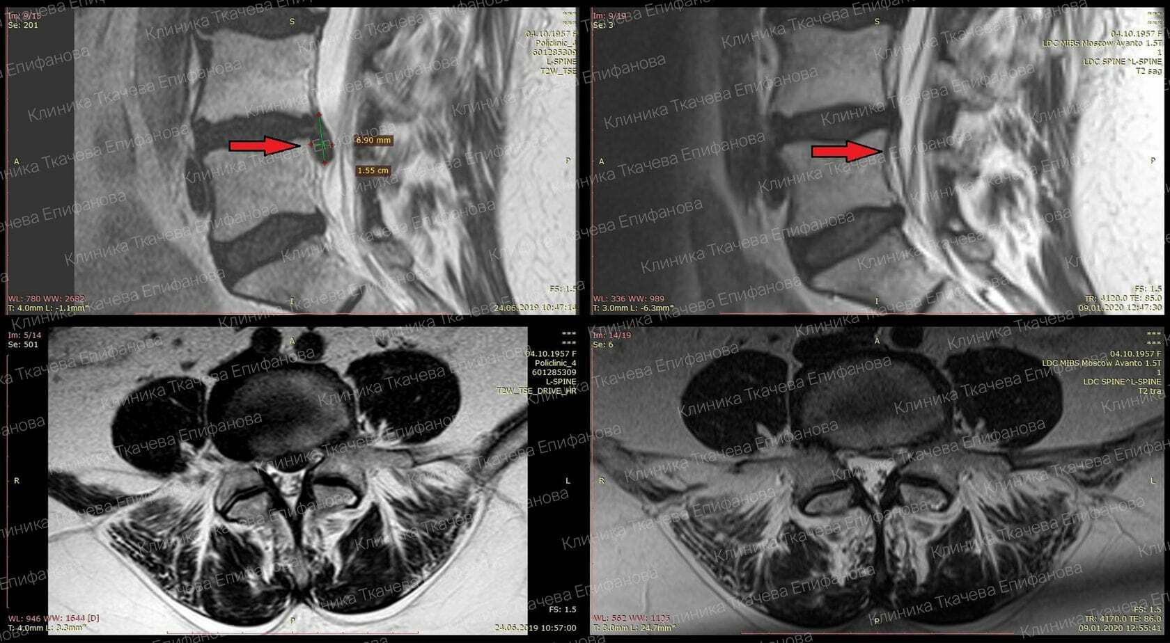 Парамедианная секвестрированная операция цена волгоград. Резорбция грыжи межпозвонкового диска. Резорбция секвестрированной грыжи. Грыжа с5-с6 шейного отдела мрт. Детензерное вытяжение позвоночника.