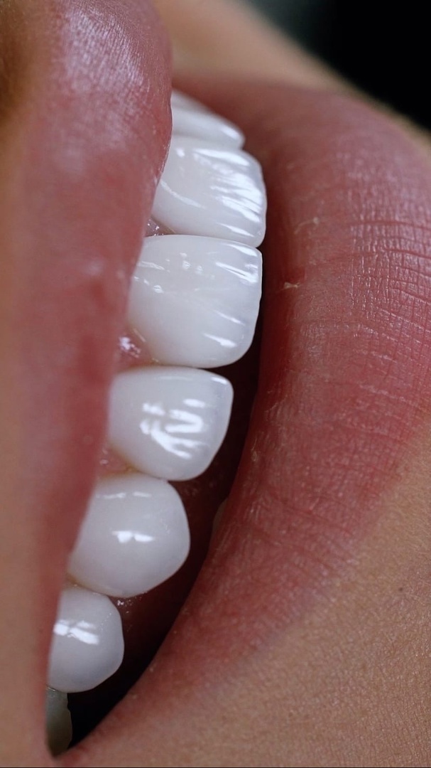 Керамические виниры E-max в Краснодаре – цены на установку