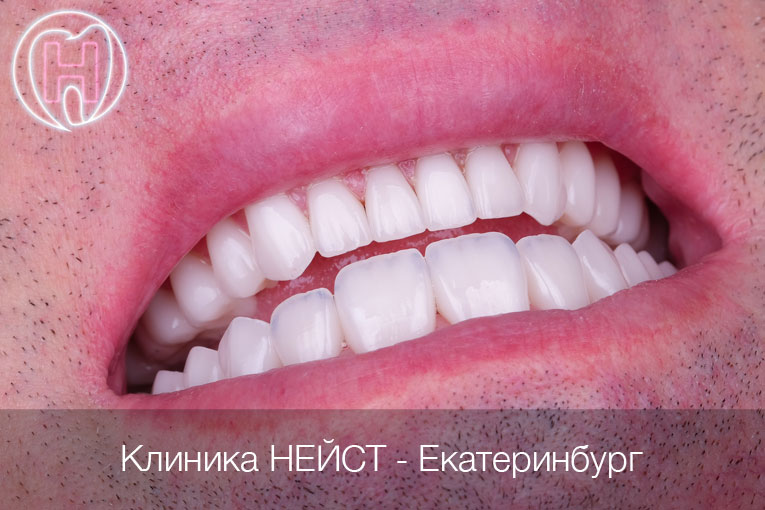 керамические виниры в Екатеринбурге цвет Блич 2 (Bleach2)